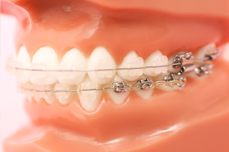 歯科矯正治療と歯科用CT