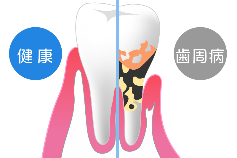 歯周病の治療