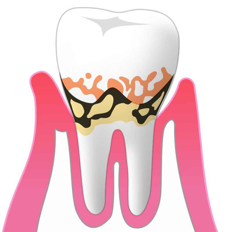 軽度の歯周病