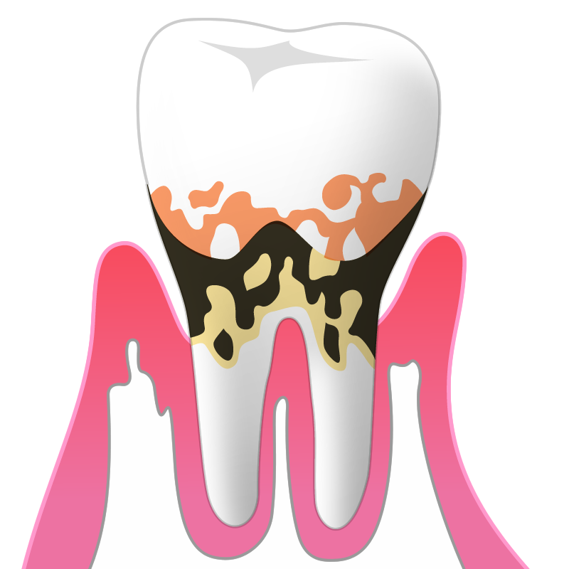 中等度の歯周病