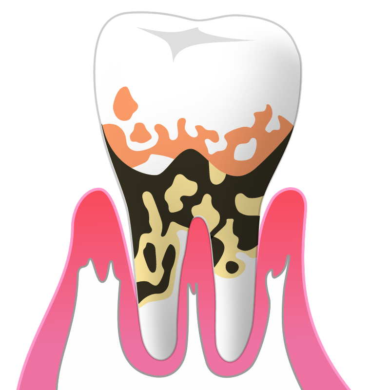 重度の歯周病